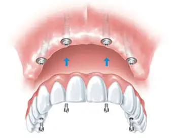 Full Arch Implant