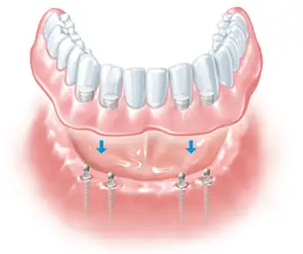 Implant Retained Dentures