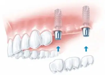 Multiple Adjoining Teeth Implant