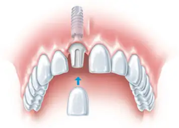 Single Tooth Implants